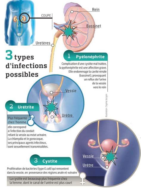 sodomie et infection urinaire|symptômes et causes de linfection urinaire